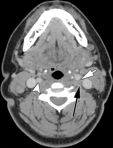 neck stl meaning|CT of the Neck: Image Analysis and Reporting in the Emergency .